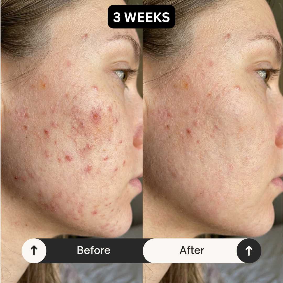 GlowSeal - Visibly Reduces Dark Marks From Skin Picking In Just 30 Days